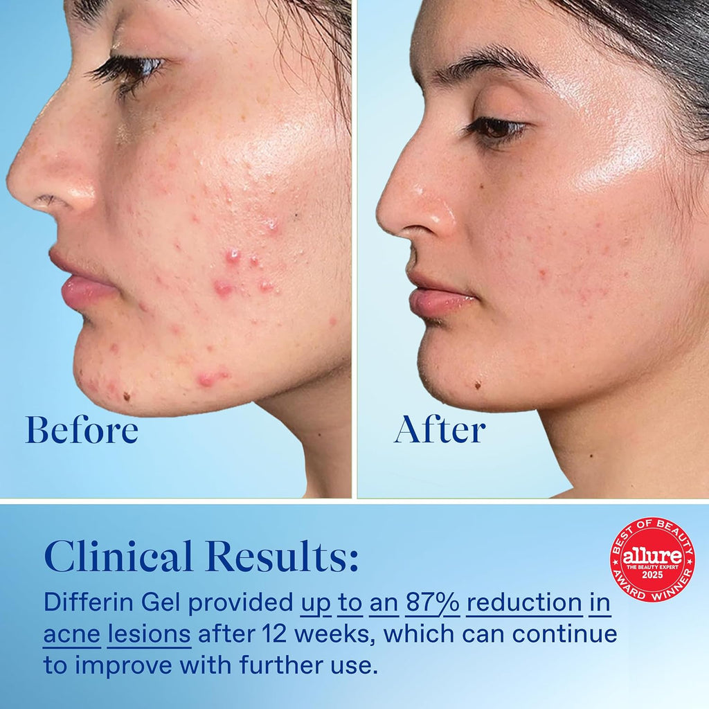 Differin Acne Treatment Gel, 30 Day Supply, Retinoid Treatment for Face with 0.1% Adapalene, Gentle Skin Care for Acne Prone Sensitive Skin, 15g Tube (Packaging May Vary) | 30-Day Supply, OTC Retinoid, Clears Acne & Prevents Breakouts, Gentle For Sensitiv