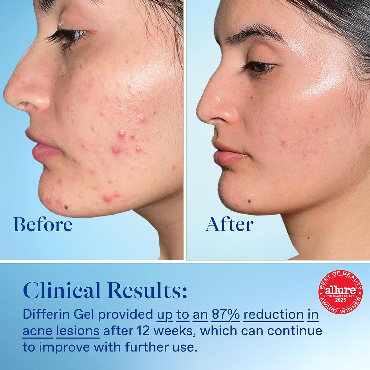 Differin Acne Treatment Gel, 30 Day Supply, Retinoid Treatment for Face with 0.1% Adapalene, Gentle Skin Care for Acne Prone Sensitive Skin, 15g Tube (Packaging May Vary) | 30-Day Supply, OTC Retinoid, Clears Acne & Prevents Breakouts, Gentle For Sensitiv
