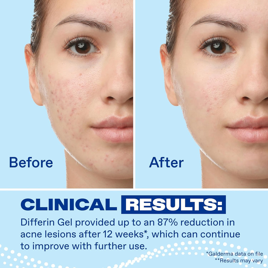 Differin Acne Treatment Gel, 30 Day Supply, Retinoid Treatment for Face with 0.1% Adapalene, Gentle Skin Care for Acne Prone Sensitive Skin, 15g Tube (Packaging May Vary) | 30-Day Supply, OTC Retinoid, Clears Acne & Prevents Breakouts, Gentle For Sensitiv